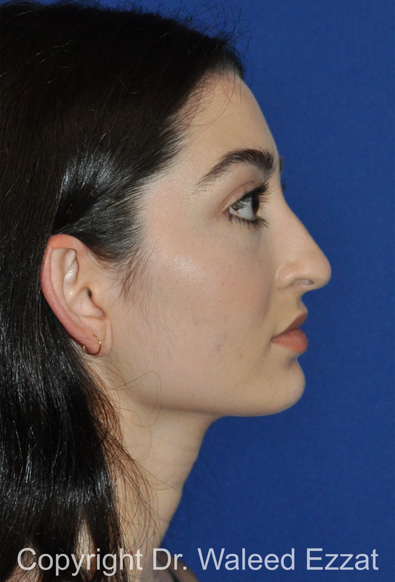 Hispanic/South American Rhinoplasty Patient Photo - Case 297 - before view-