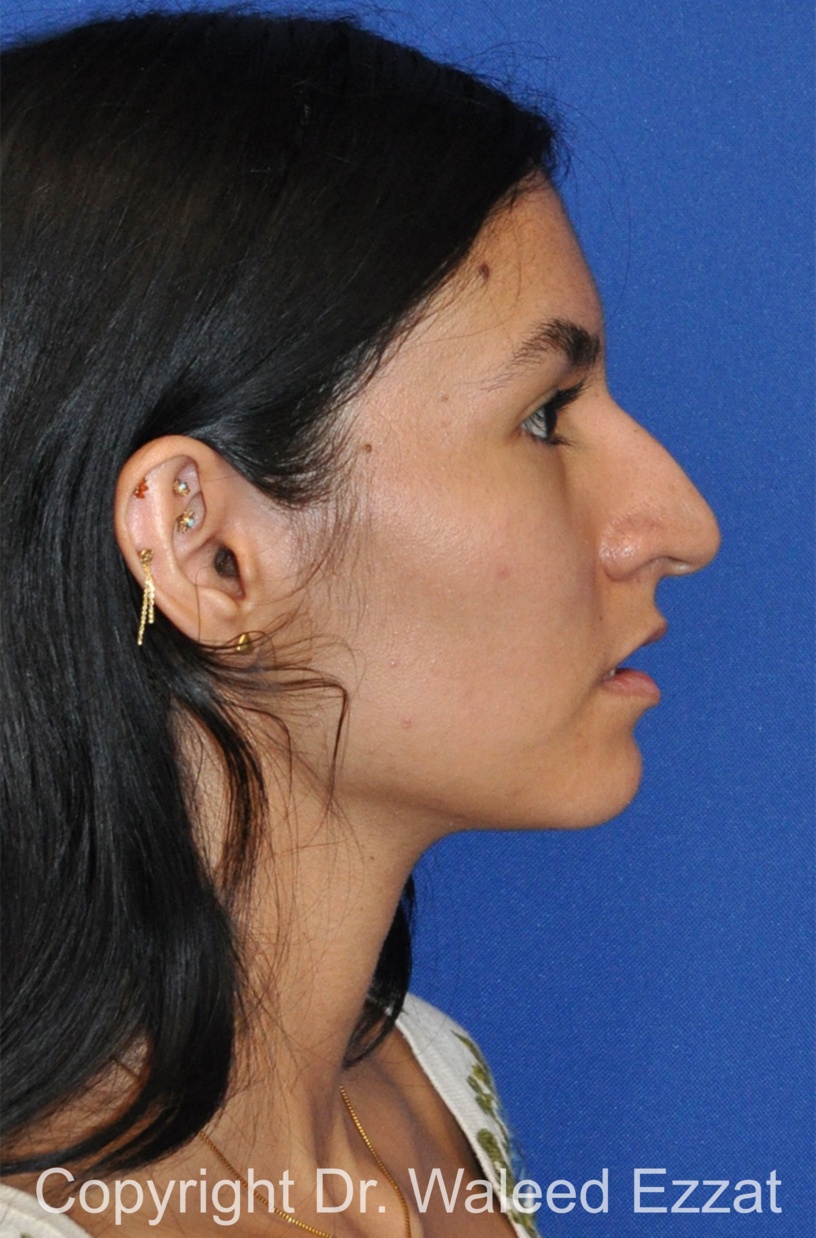 Hispanic/South American Rhinoplasty Patient Photo - Case 298 - before view-