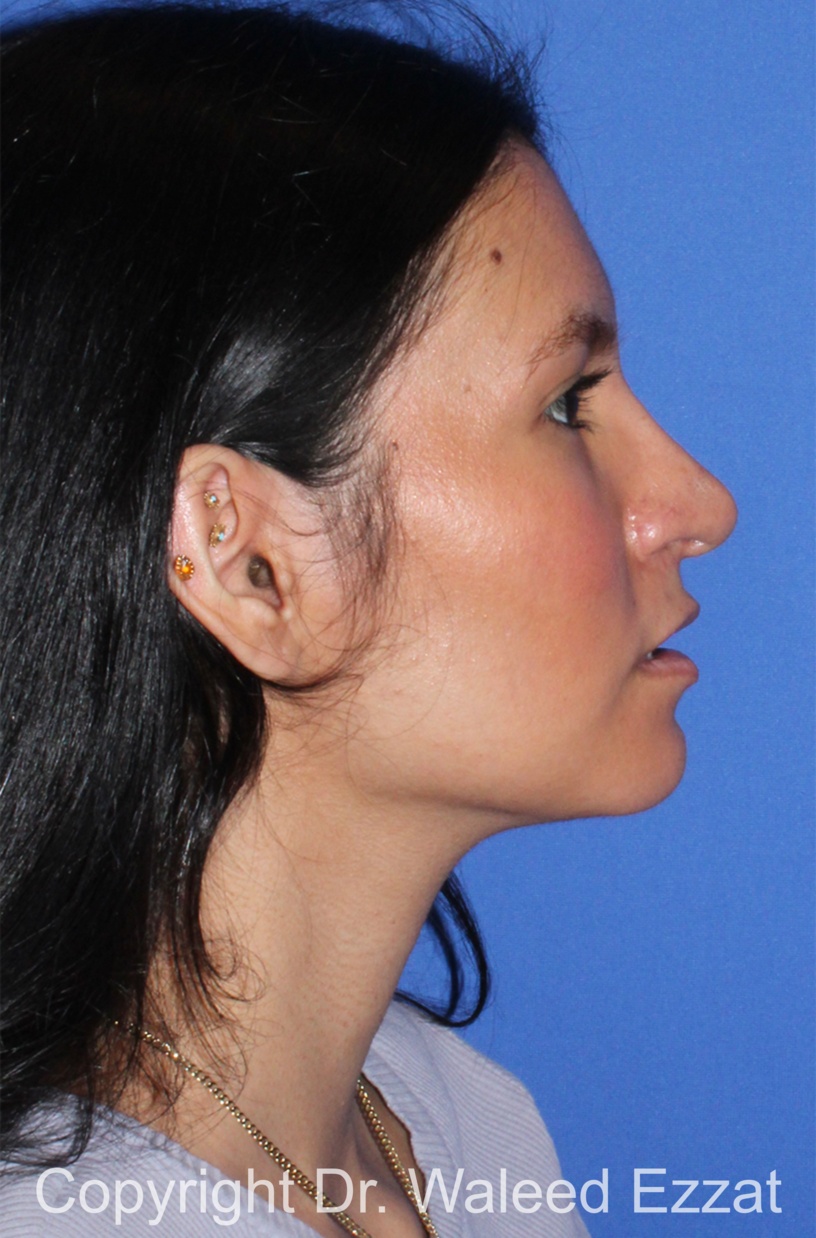 Hispanic/South American Rhinoplasty Patient Photo - Case 298 - after view