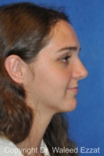 Hispanic/South American Rhinoplasty - Case 299 - After