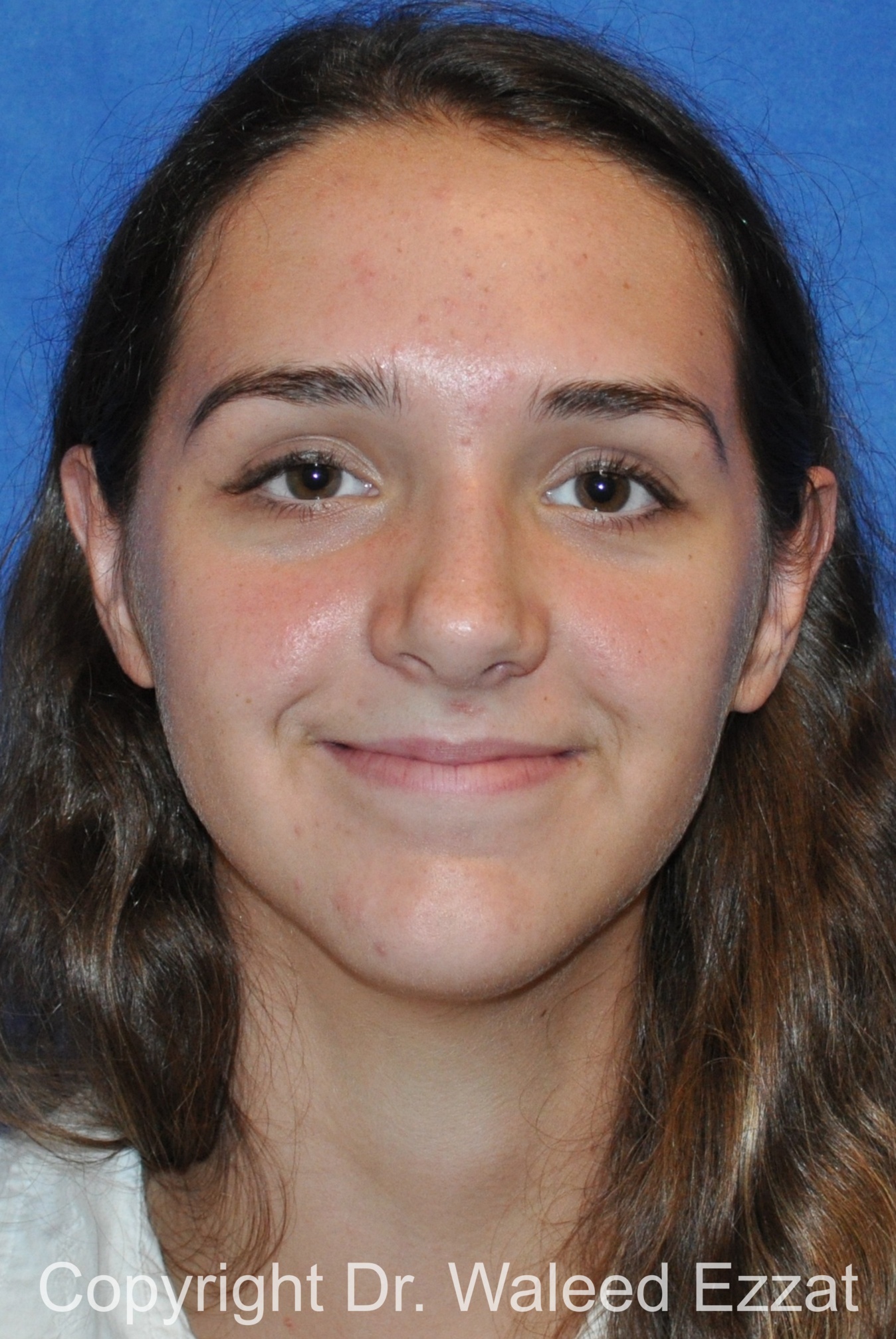 Hispanic/South American Rhinoplasty Patient Photo - Case 299 - after view-2