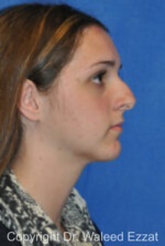 Hispanic/South American Rhinoplasty - Case 299 - Before