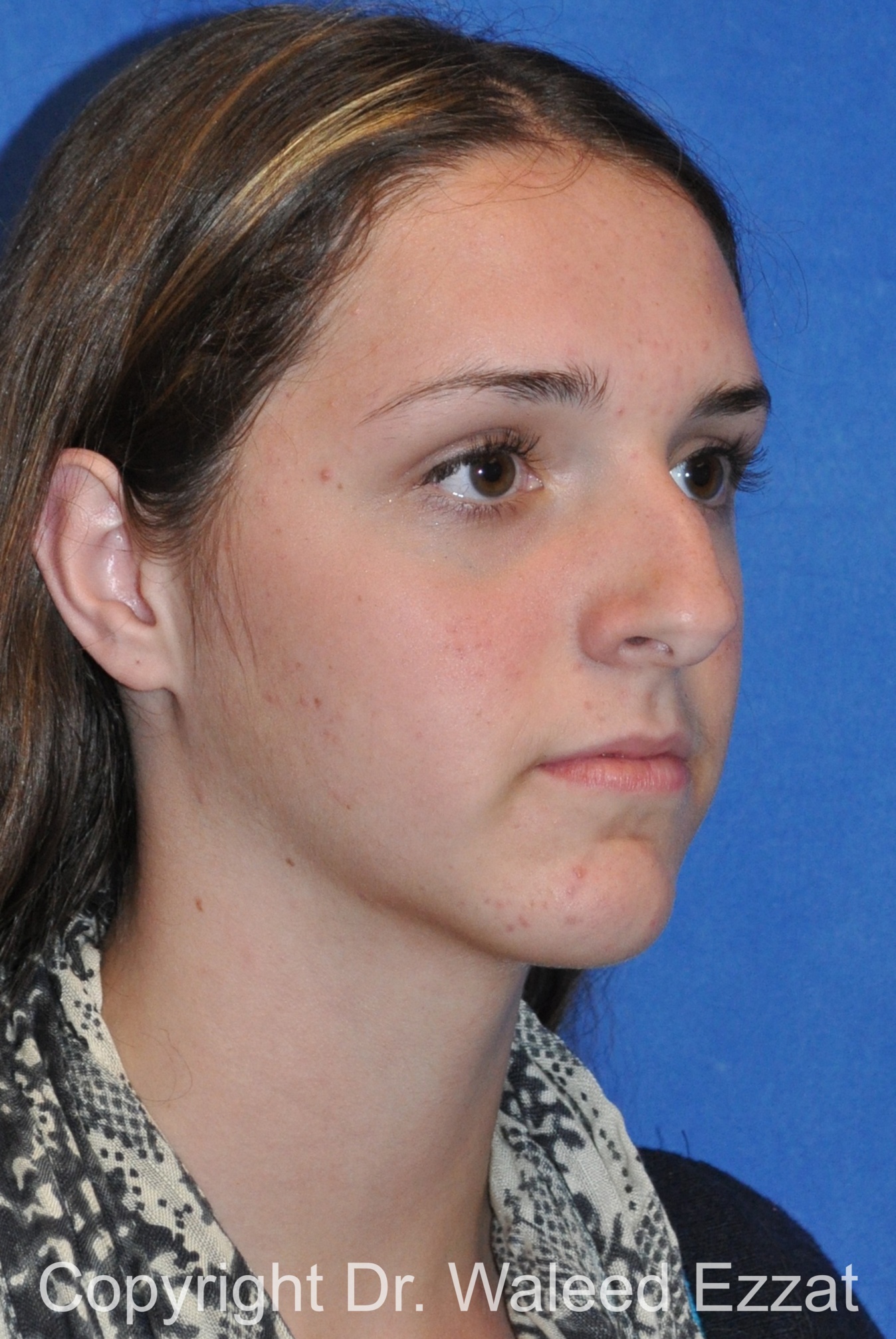 Hispanic/South American Rhinoplasty Patient Photo - Case 299 - before view-1