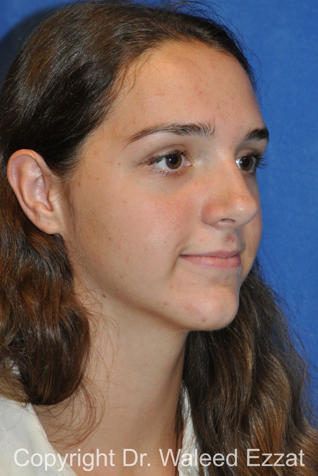 Hispanic/South American Rhinoplasty Patient Photo - Case 299 - after view-1