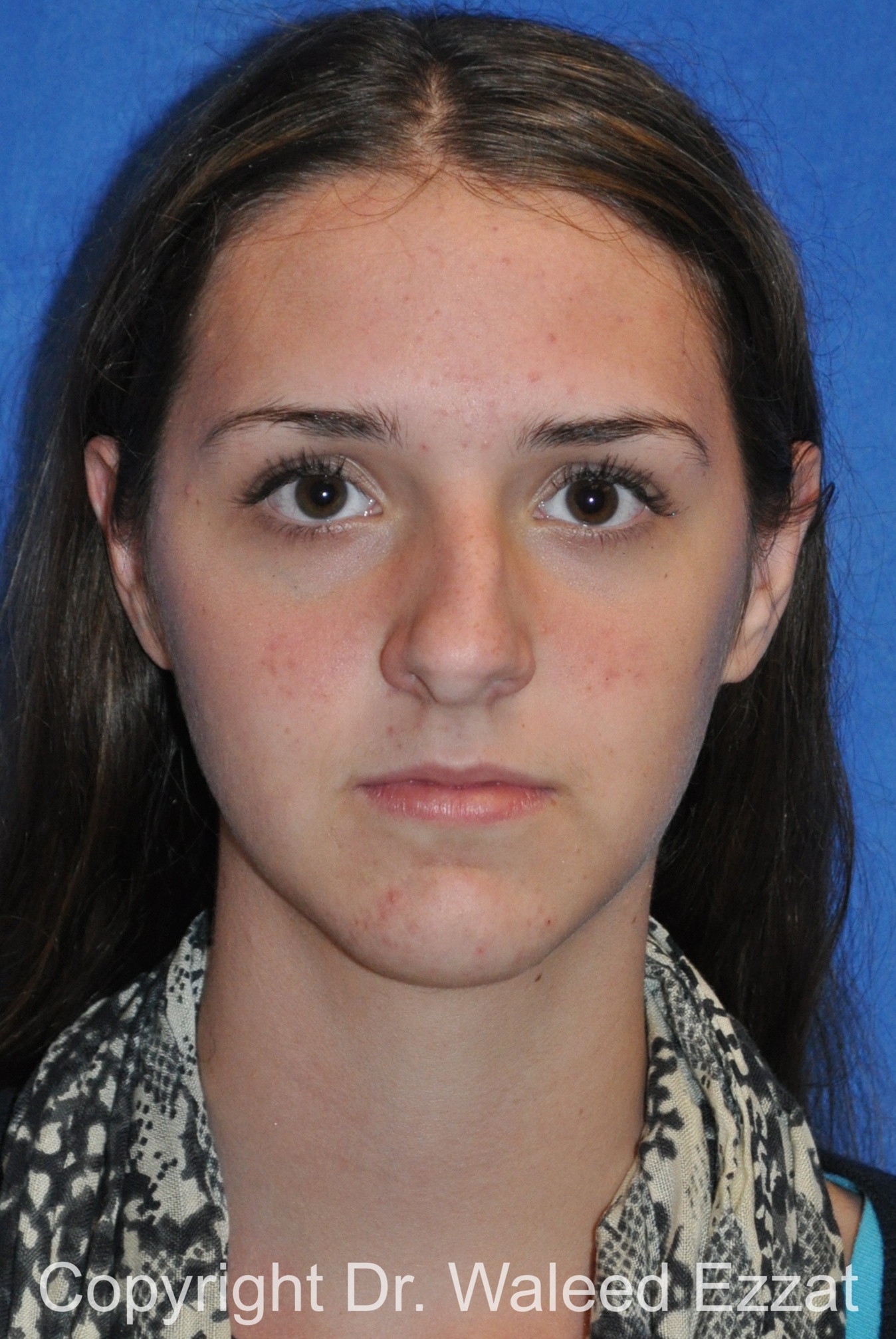 Hispanic/South American Rhinoplasty Patient Photo - Case 299 - before view-2