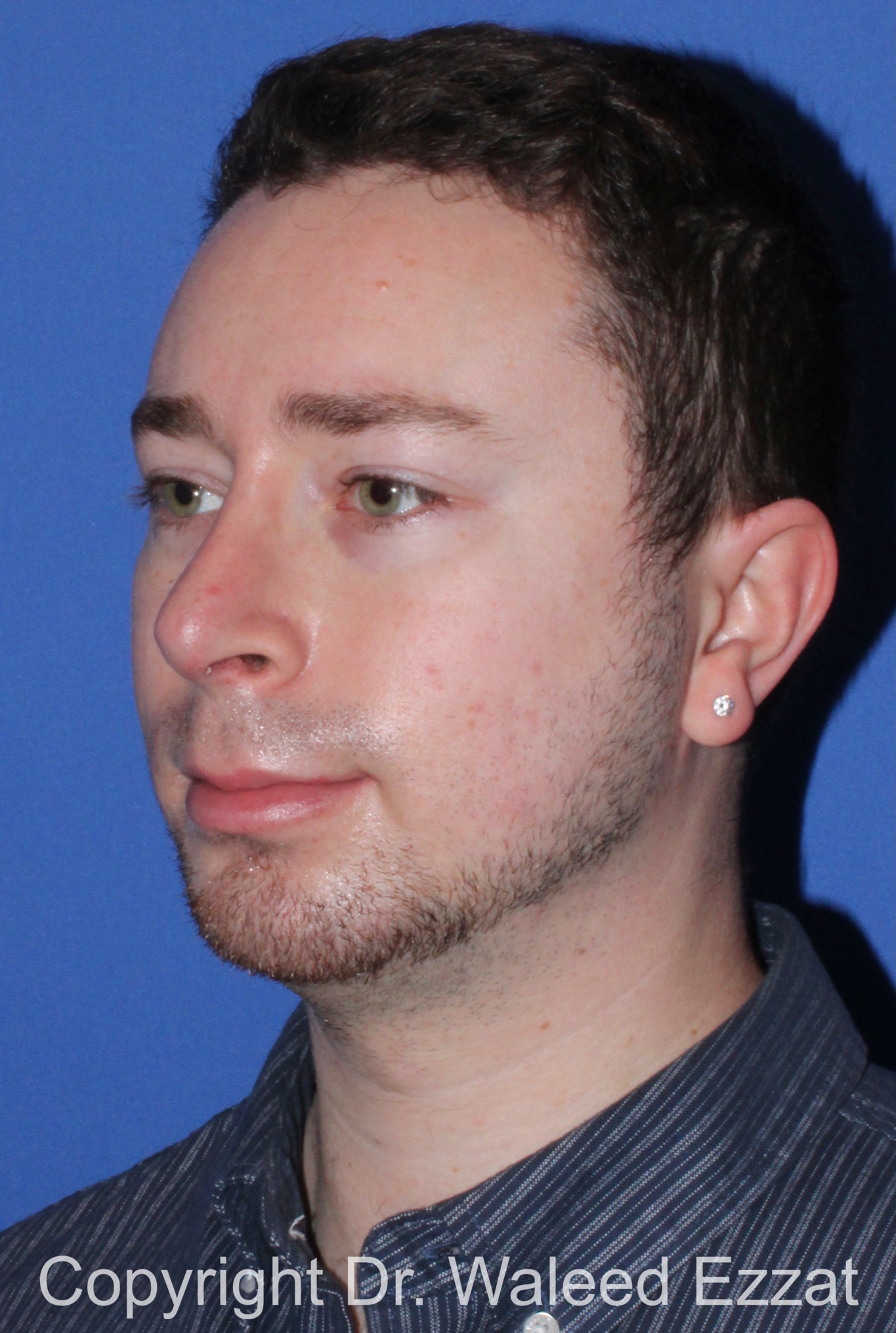 Male Rhinoplasty Patient Photo - Case 37 - after view-3