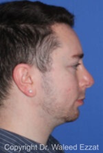 Male Rhinoplasty - Case 37 - After