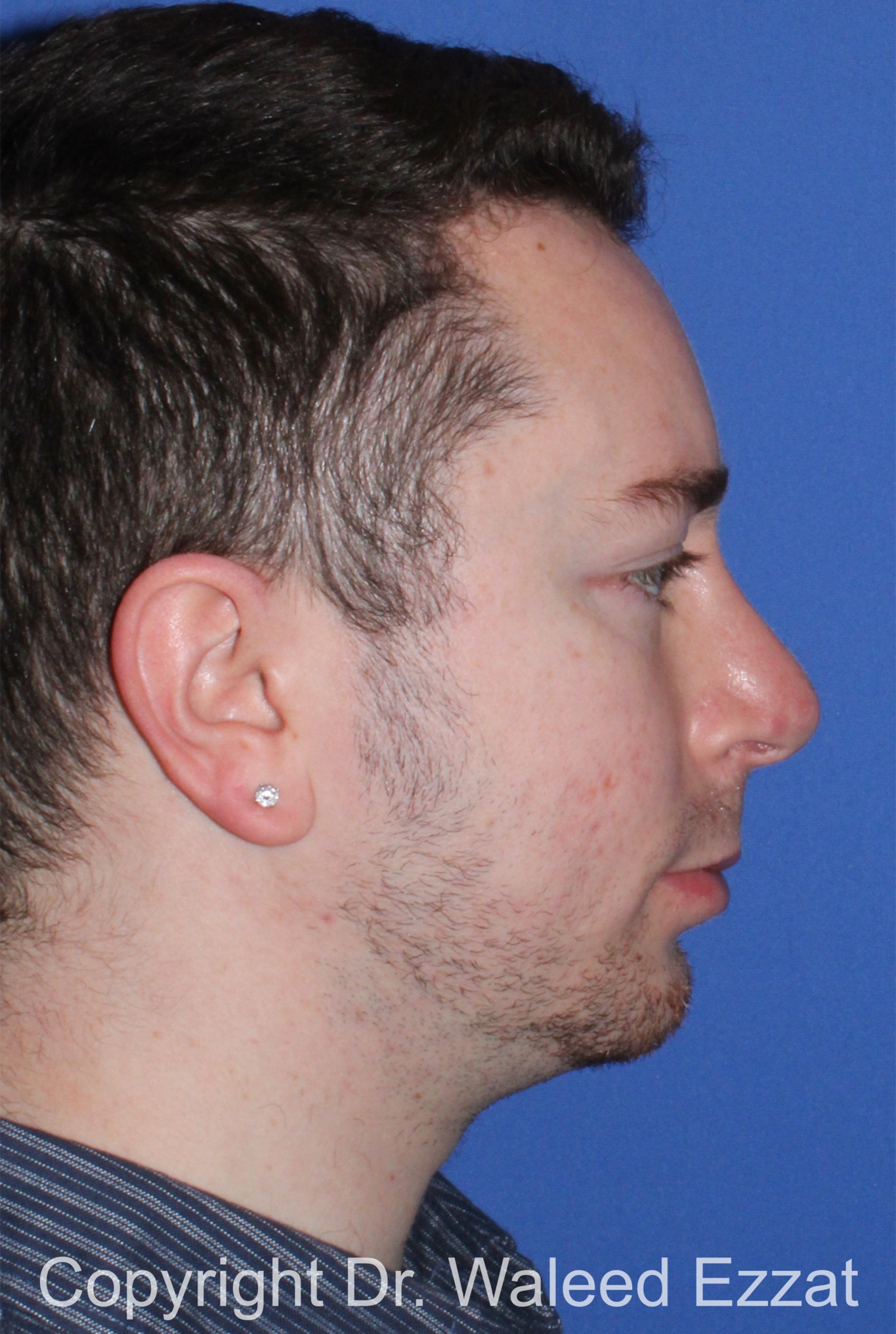 Male Rhinoplasty Patient Photo - Case 37 - after view