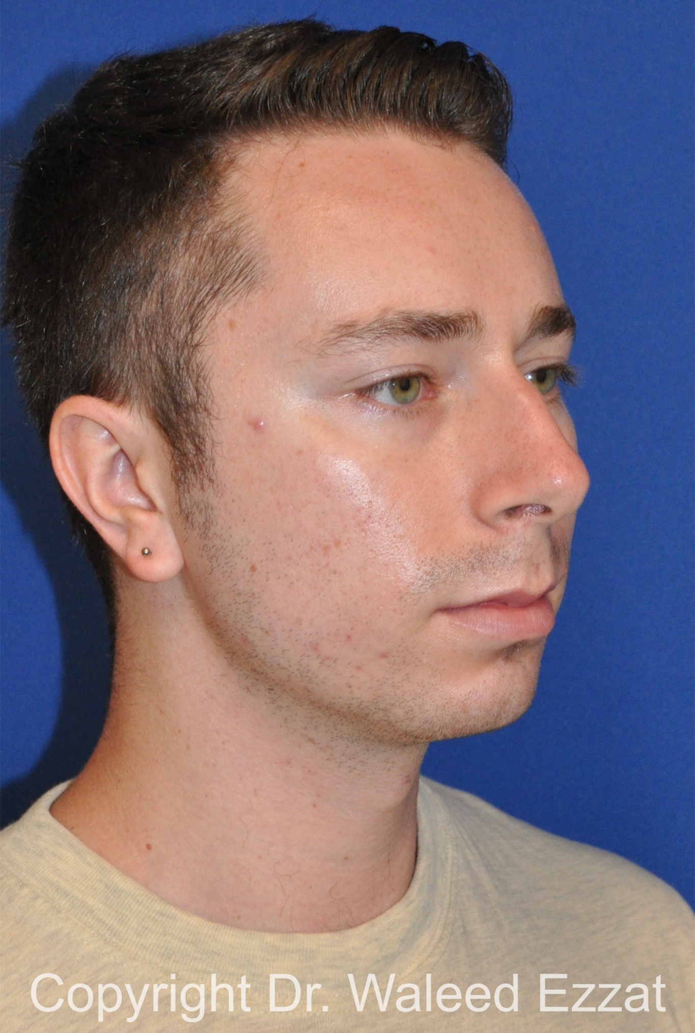 Male Rhinoplasty Patient Photo - Case 37 - before view-1
