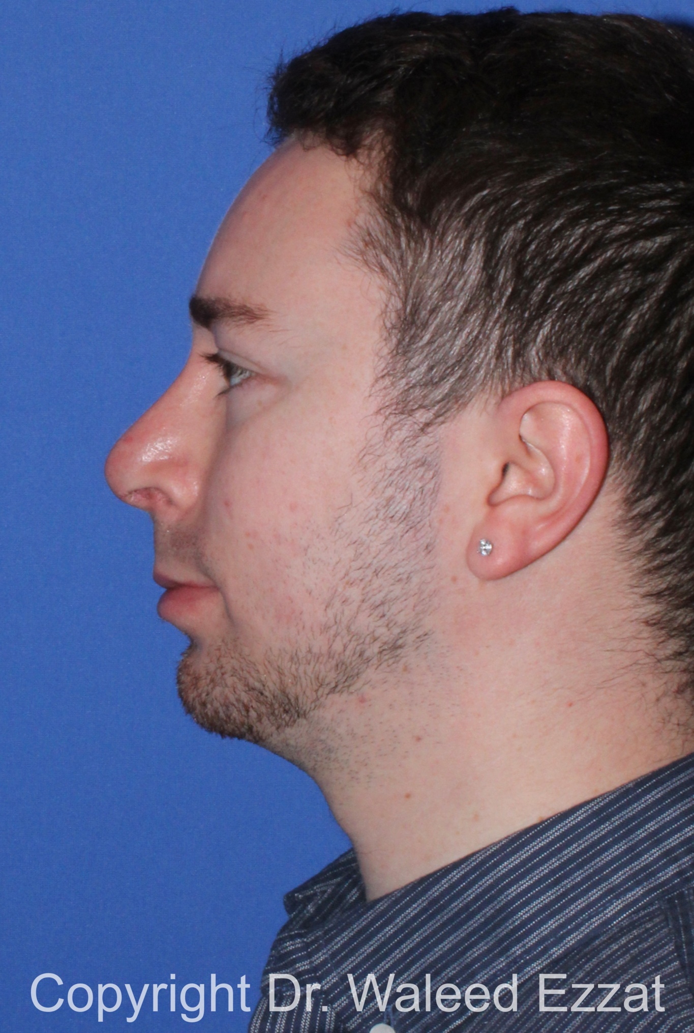 Male Rhinoplasty Patient Photo - Case 37 - after view-2