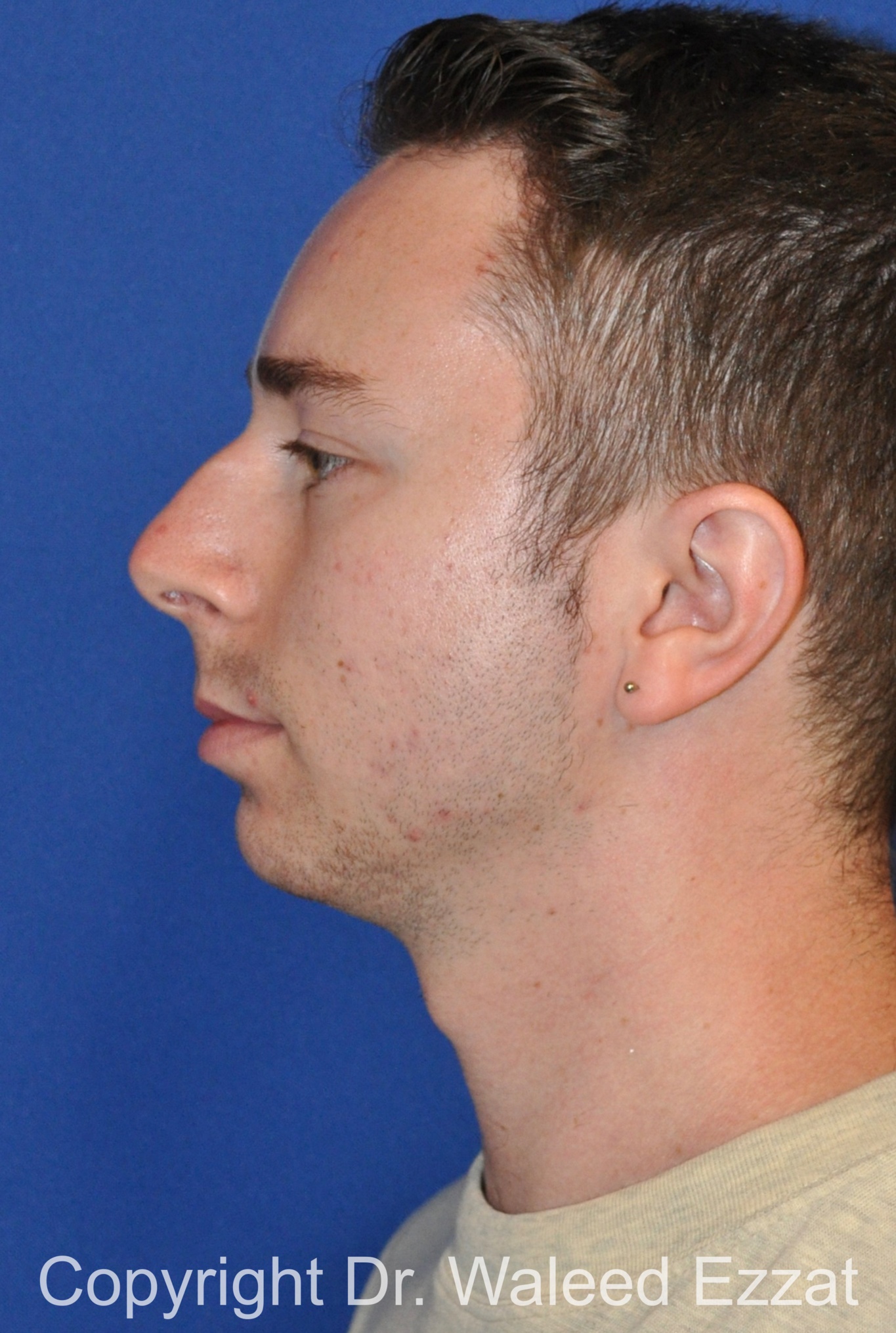 Male Rhinoplasty Patient Photo - Case 37 - before view-2