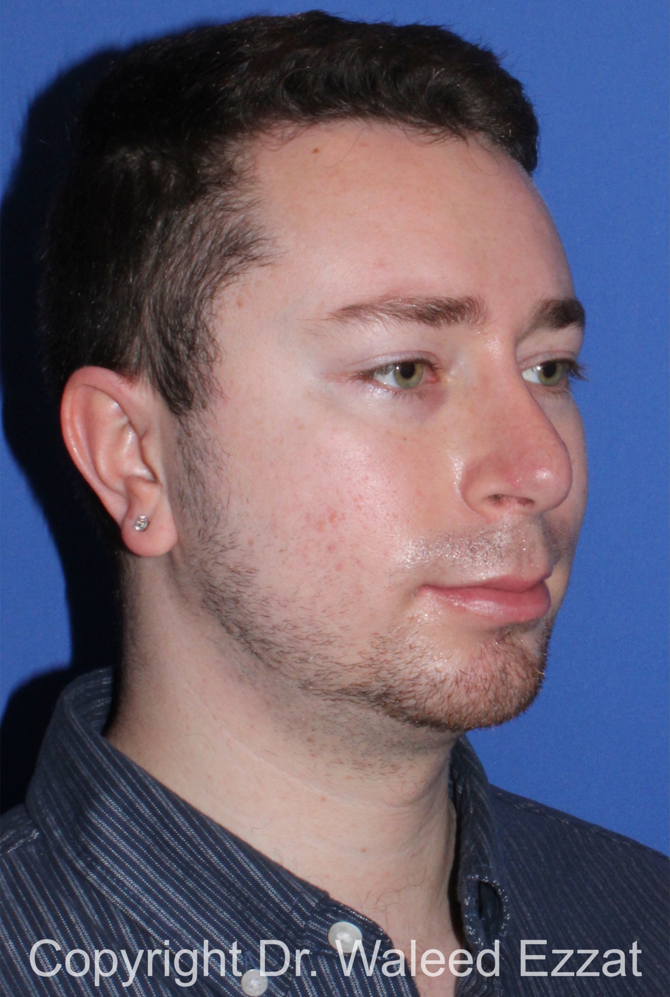 Male Rhinoplasty Patient Photo - Case 37 - after view-1