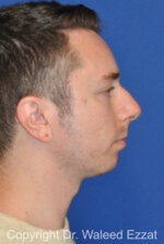 Male Rhinoplasty - Case 37 - Before