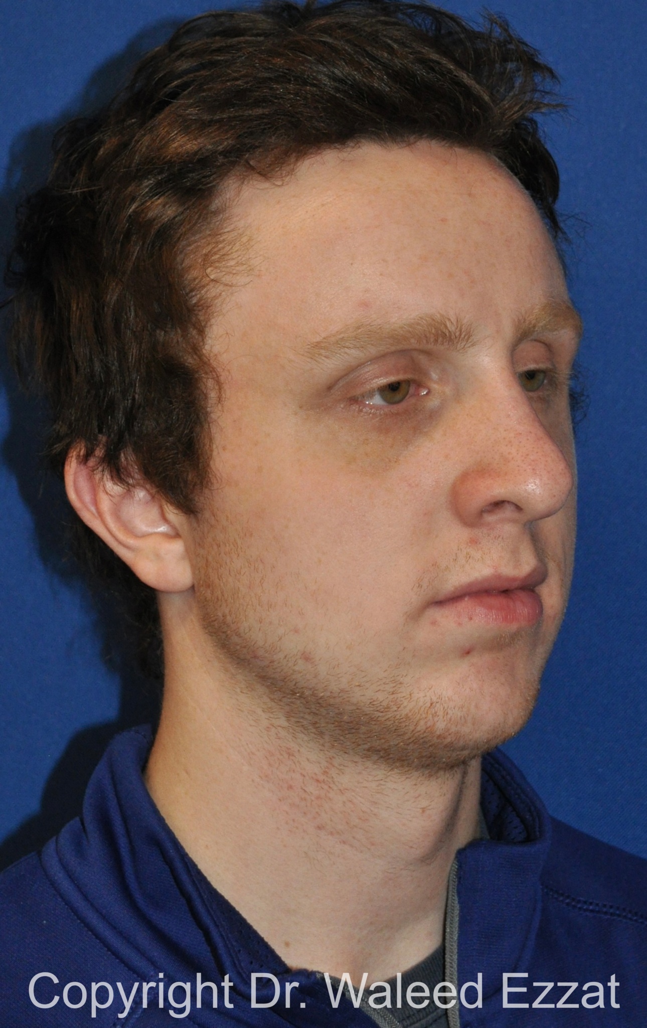 Male Rhinoplasty Patient Photo - Case 62 - after view-1