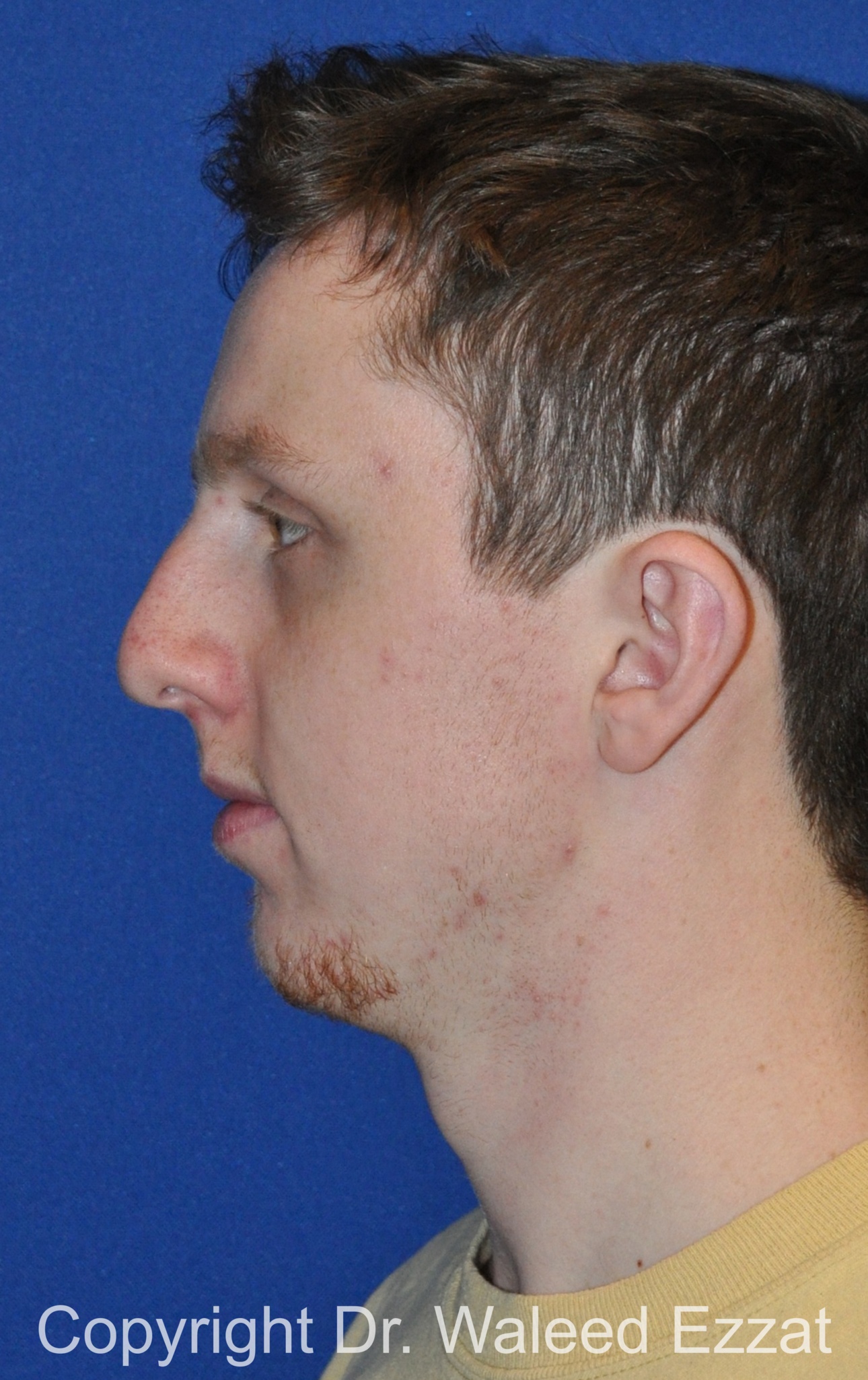 Male Rhinoplasty Patient Photo - Case 62 - before view-2