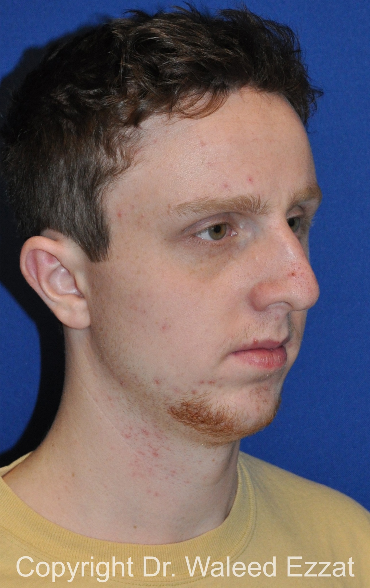Male Rhinoplasty Patient Photo - Case 62 - before view-1