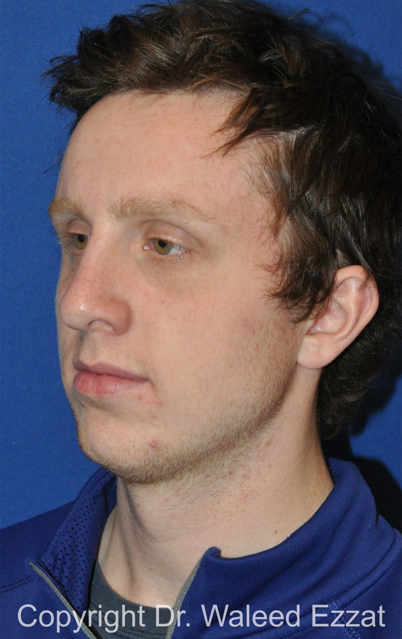 Male Rhinoplasty Patient Photo - Case 62 - after view-3