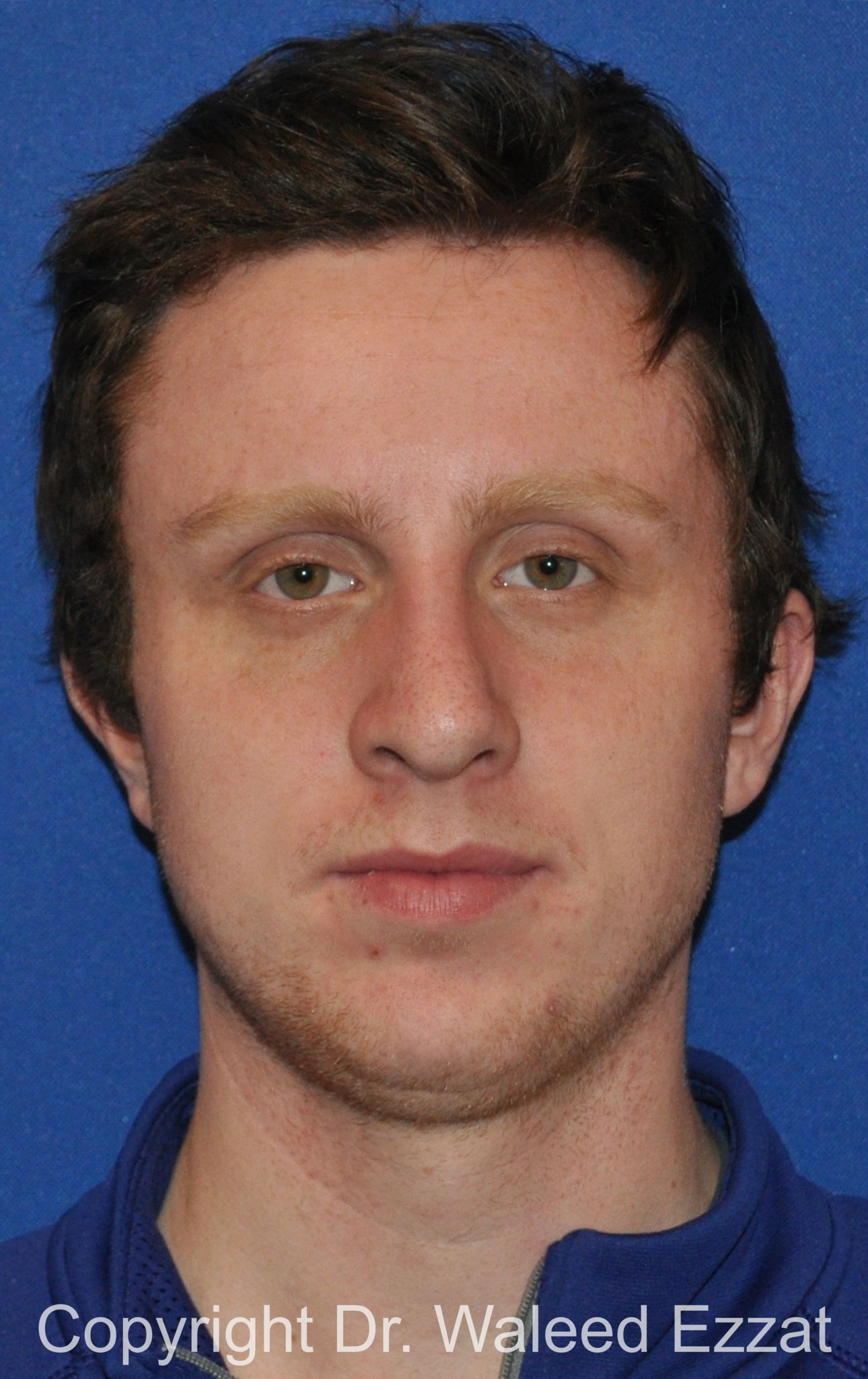 Male Rhinoplasty Patient Photo - Case 62 - after view-4