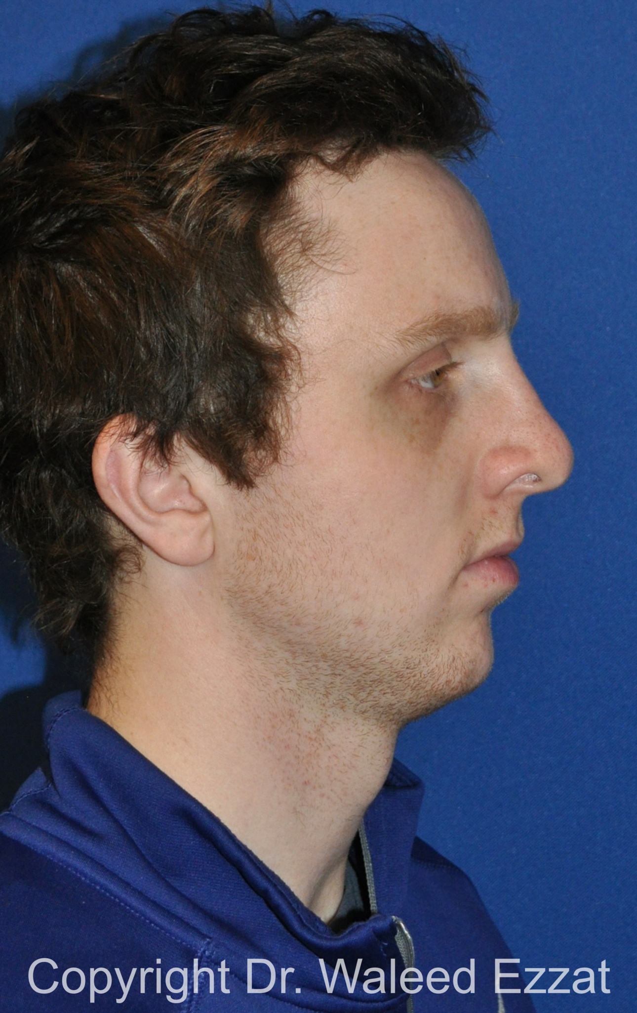 Male Rhinoplasty Patient Photo - Case 62 - after view