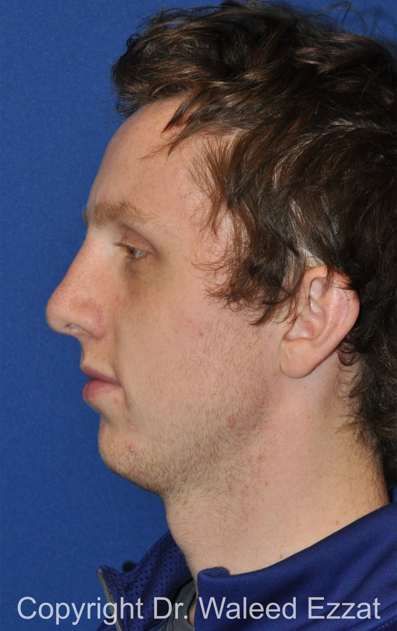 Male Rhinoplasty Patient Photo - Case 62 - after view-2