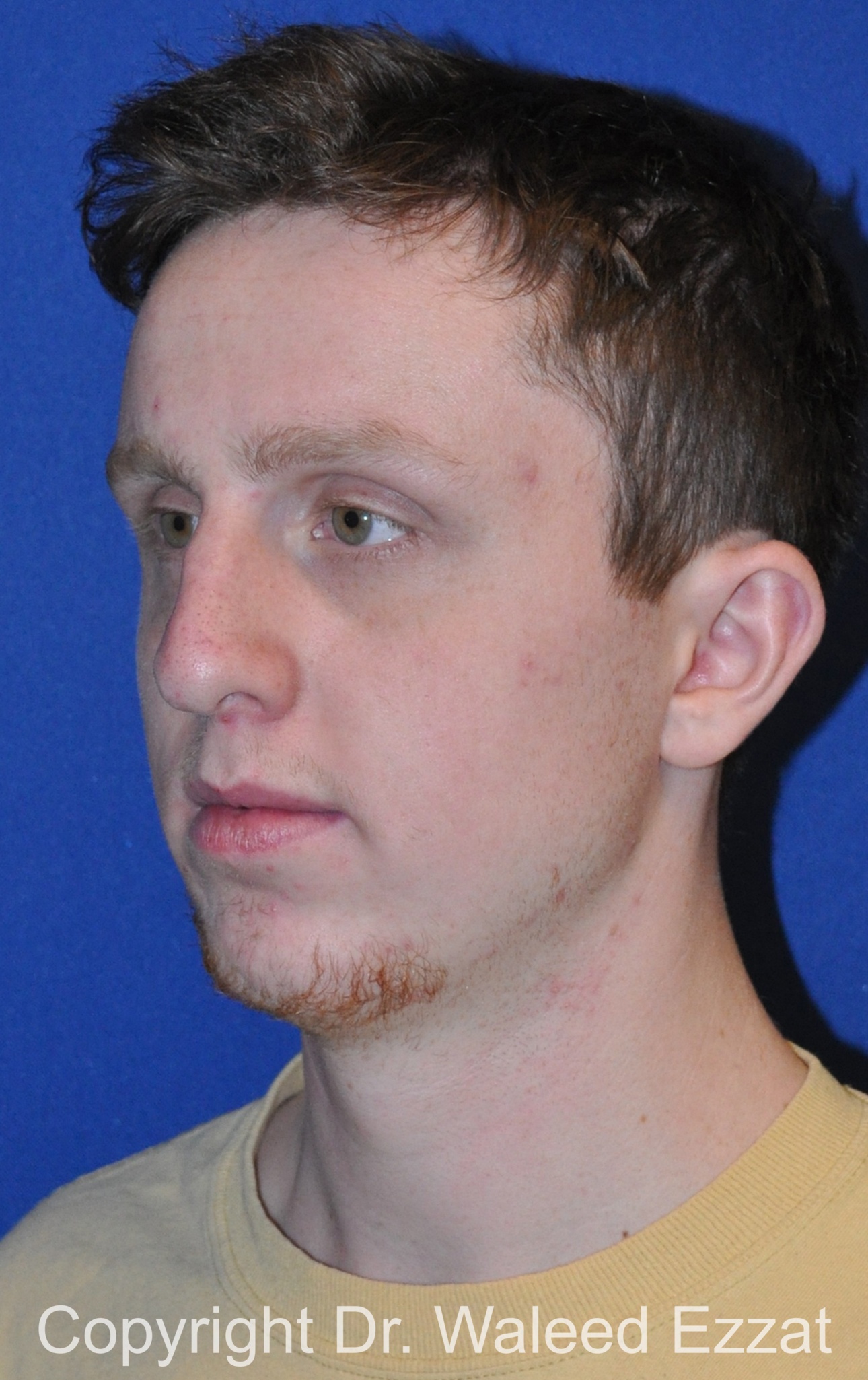Male Rhinoplasty Patient Photo - Case 62 - before view-3