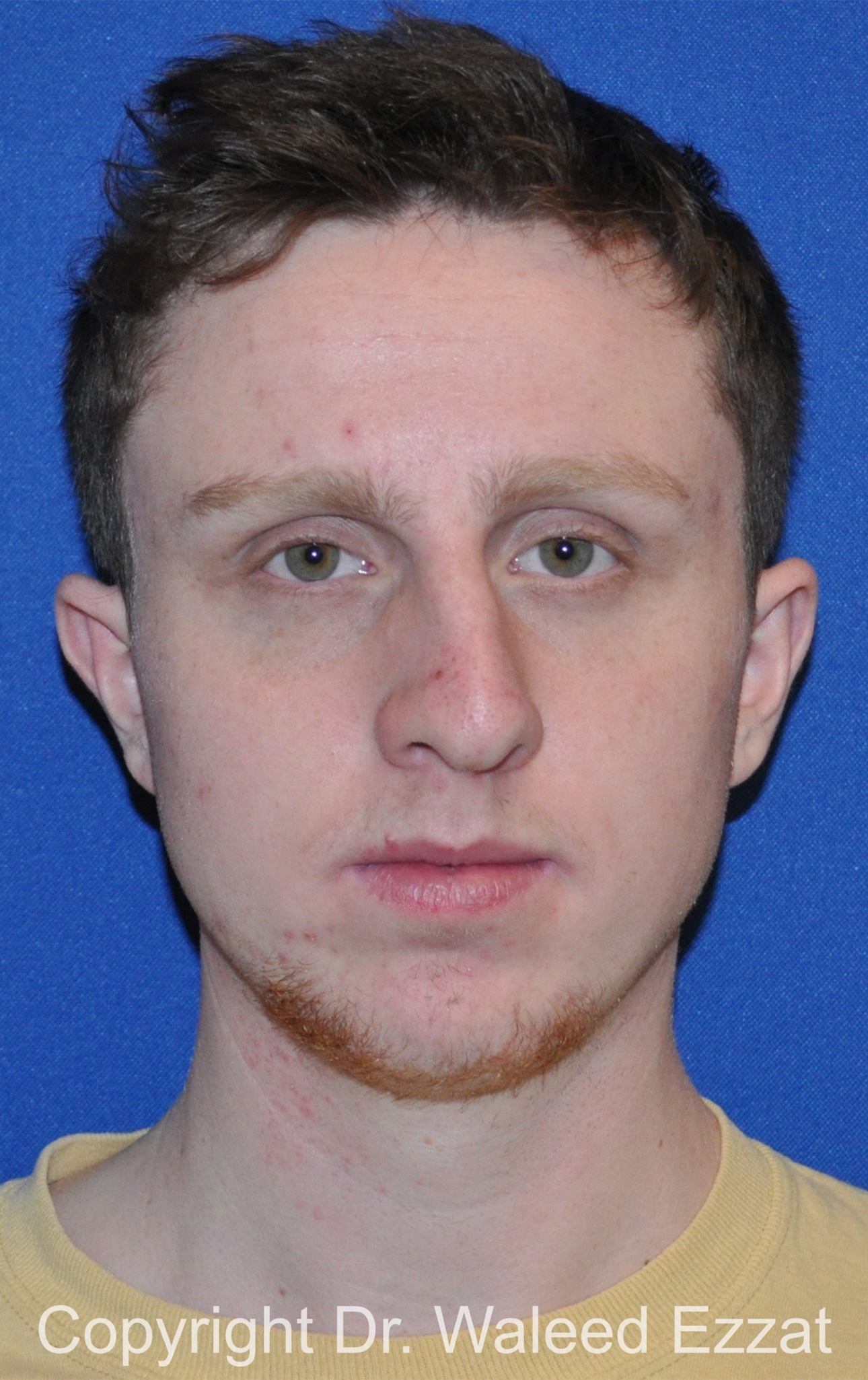 Male Rhinoplasty Patient Photo - Case 62 - before view-4