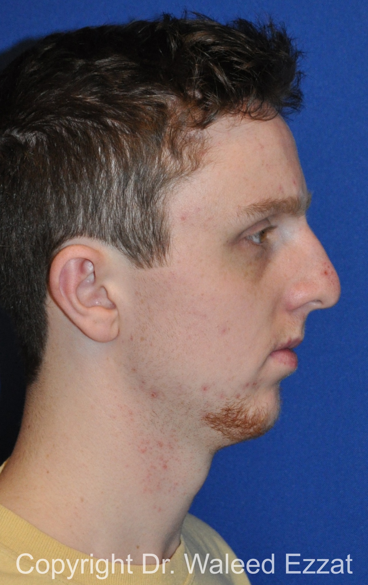 Male Rhinoplasty Patient Photo - Case 62 - before view-