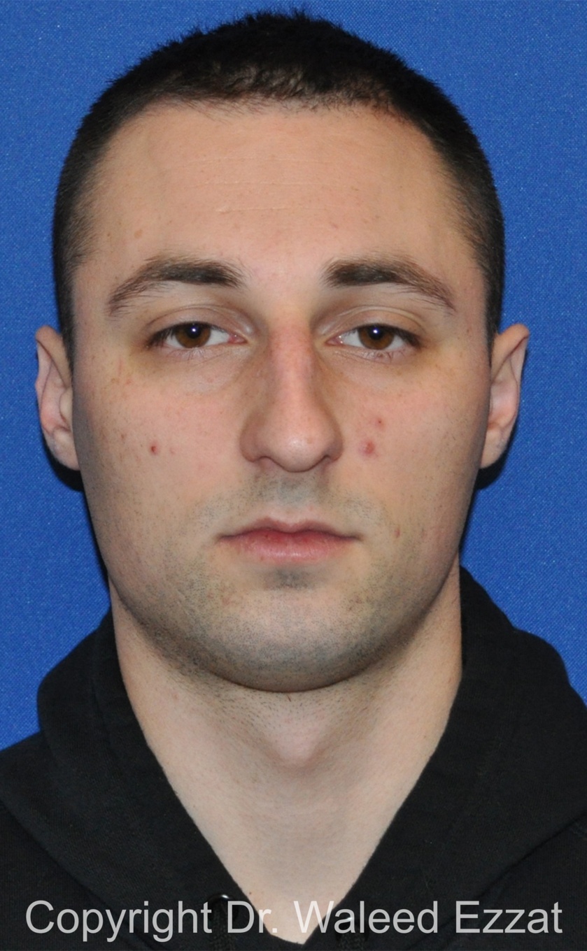 Male Rhinoplasty Patient Photo - Case 63 - before view-2