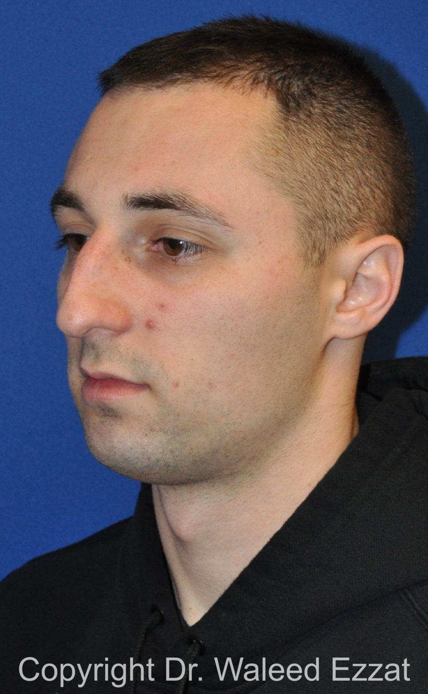 Male Rhinoplasty Patient Photo - Case 63 - before view-1