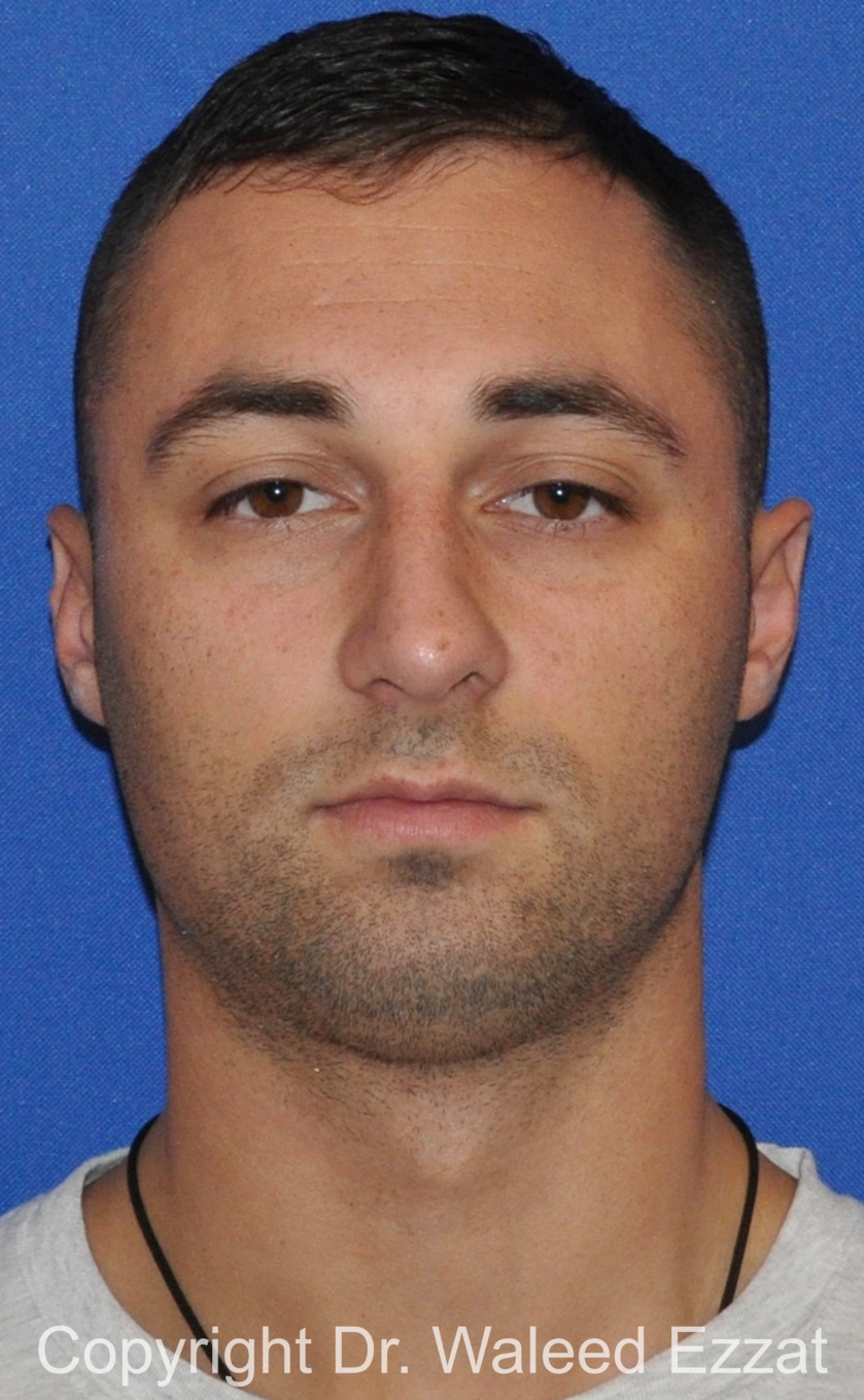 Male Rhinoplasty Patient Photo - Case 63 - after view-2