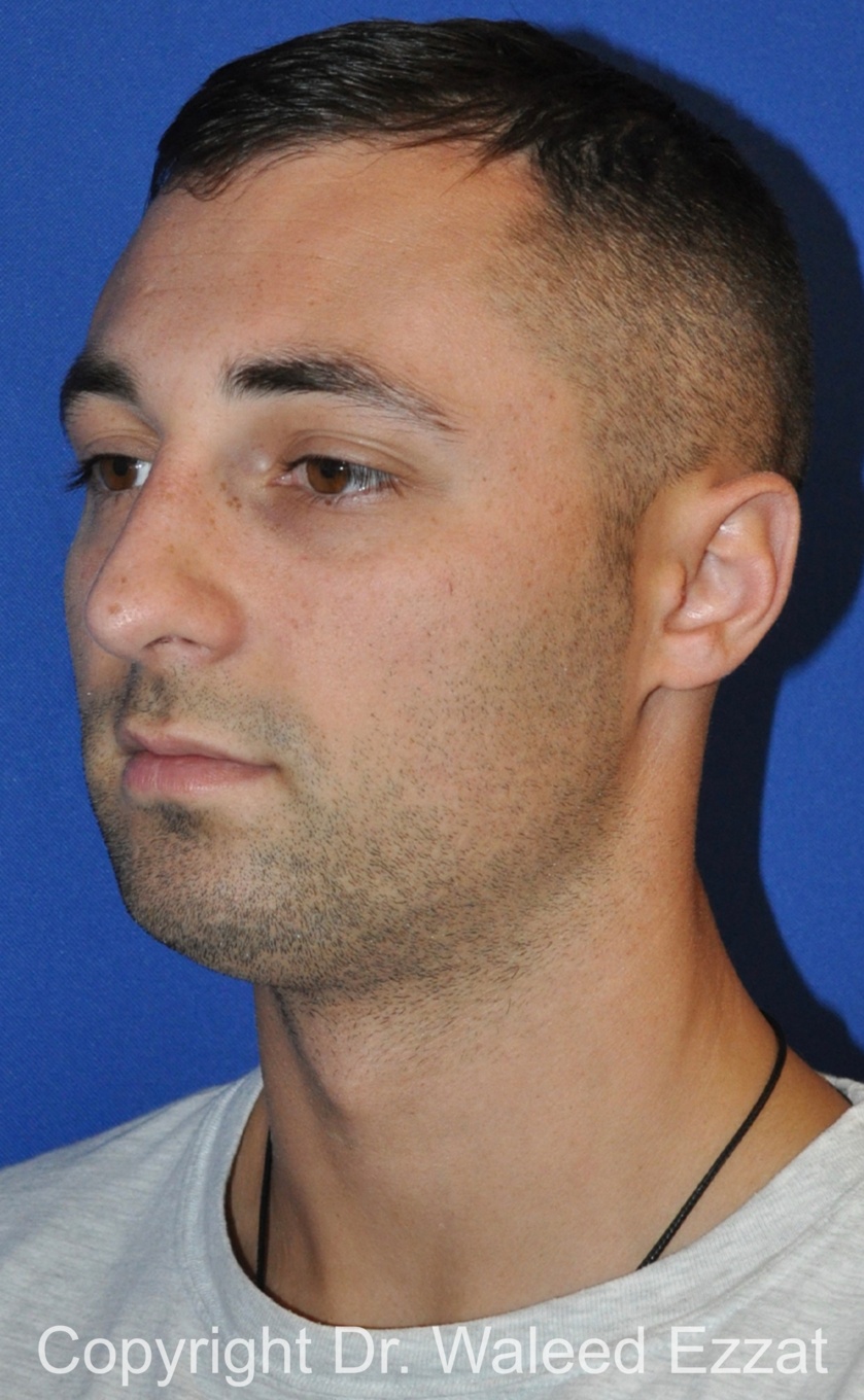 Male Rhinoplasty Patient Photo - Case 63 - after view-1