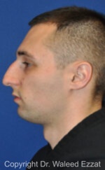 Male Rhinoplasty - Case 63 - Before
