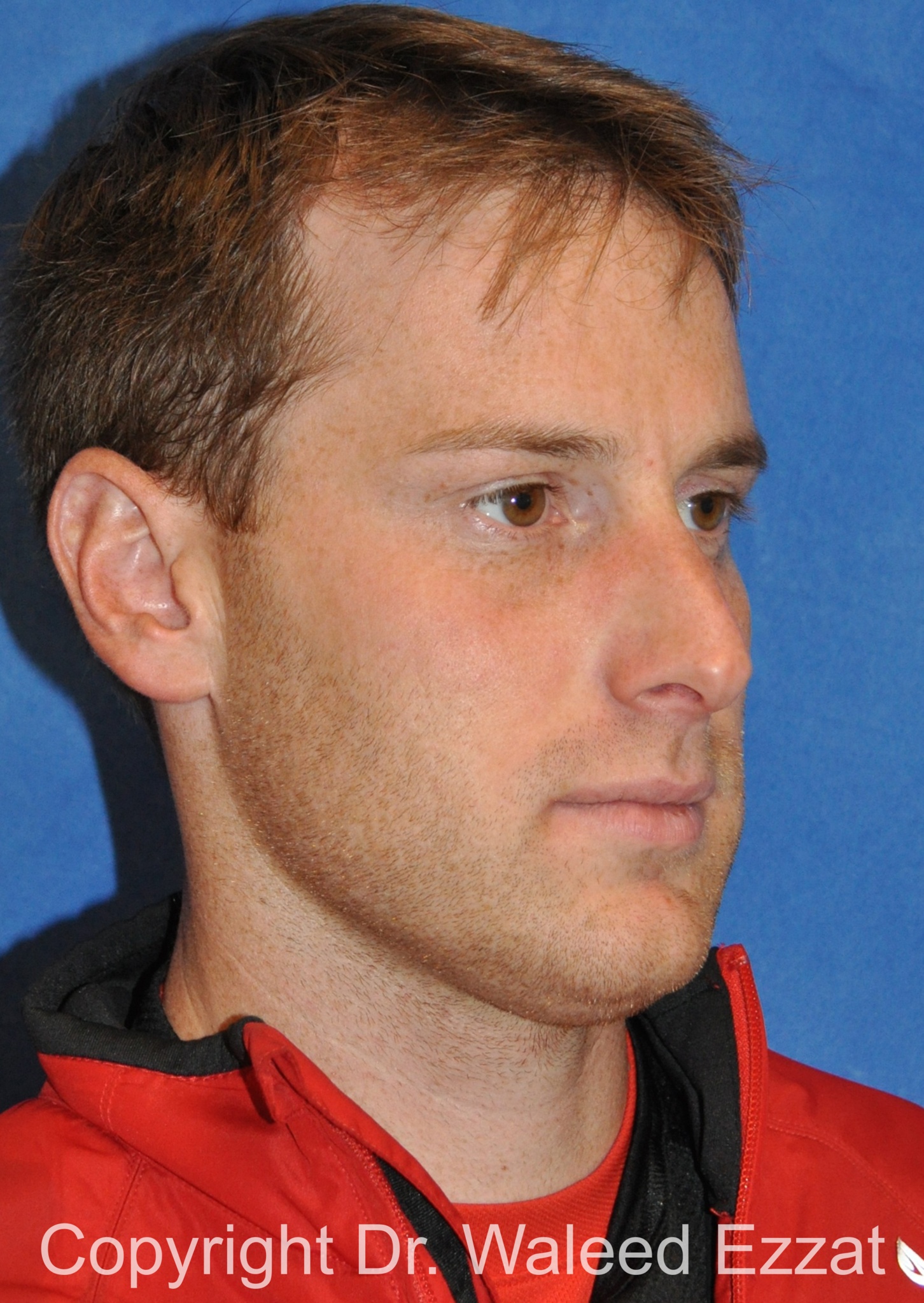 Male Rhinoplasty Patient Photo - Case 64 - before view-1