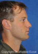 Male Rhinoplasty - Case 64 - After