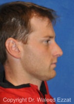 Male Rhinoplasty - Case 64 - Before