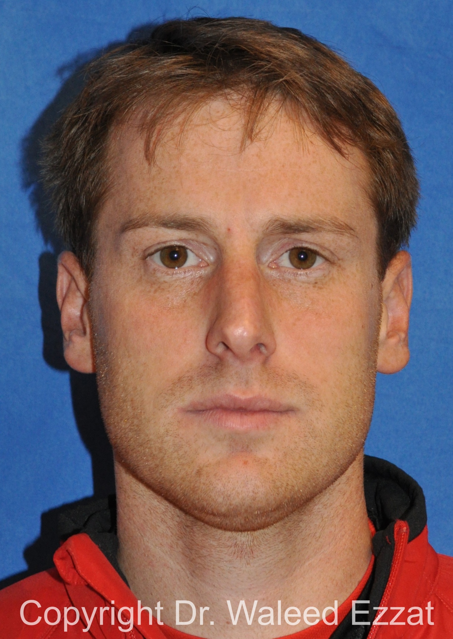 Male Rhinoplasty Patient Photo - Case 64 - before view-2