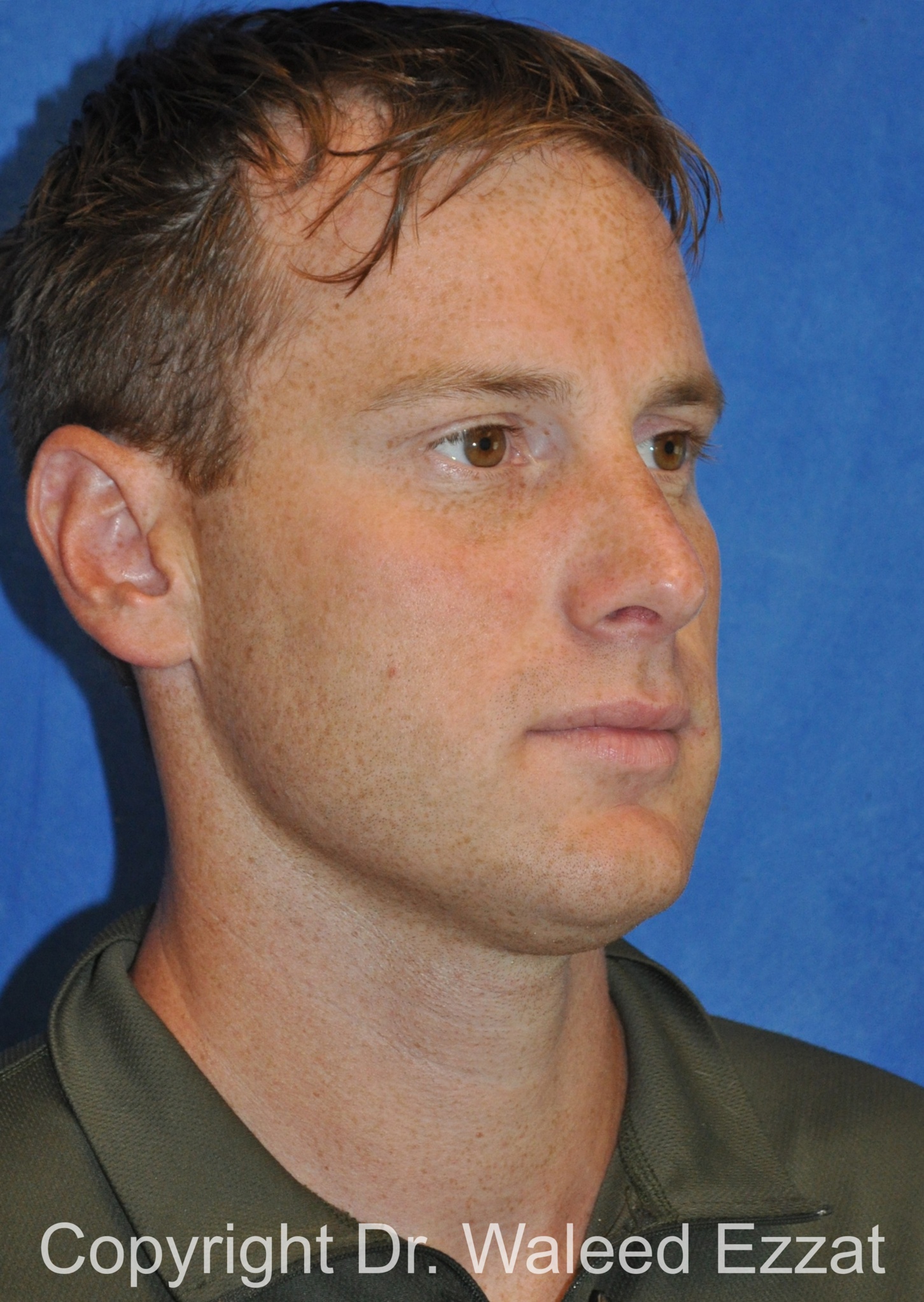 Male Rhinoplasty Patient Photo - Case 64 - after view-1