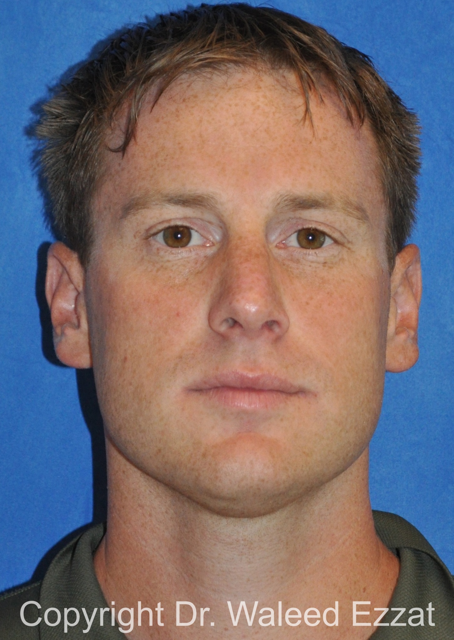 Male Rhinoplasty Patient Photo - Case 64 - after view-2