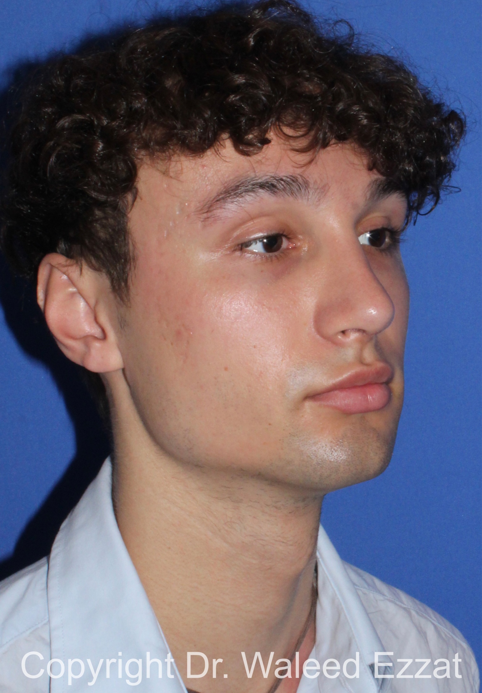 Male Rhinoplasty Patient Photo - Case 65 - after view-1