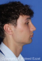 Male Rhinoplasty - Case 65 - After