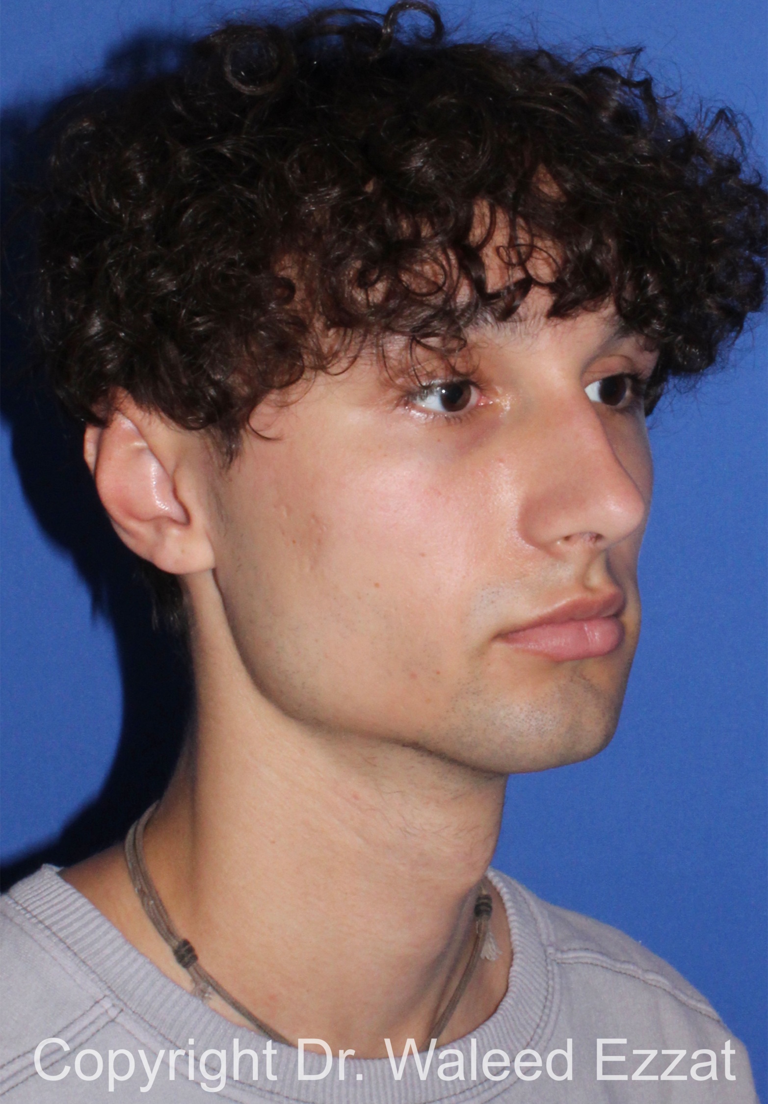 Male Rhinoplasty Patient Photo - Case 65 - before view-1