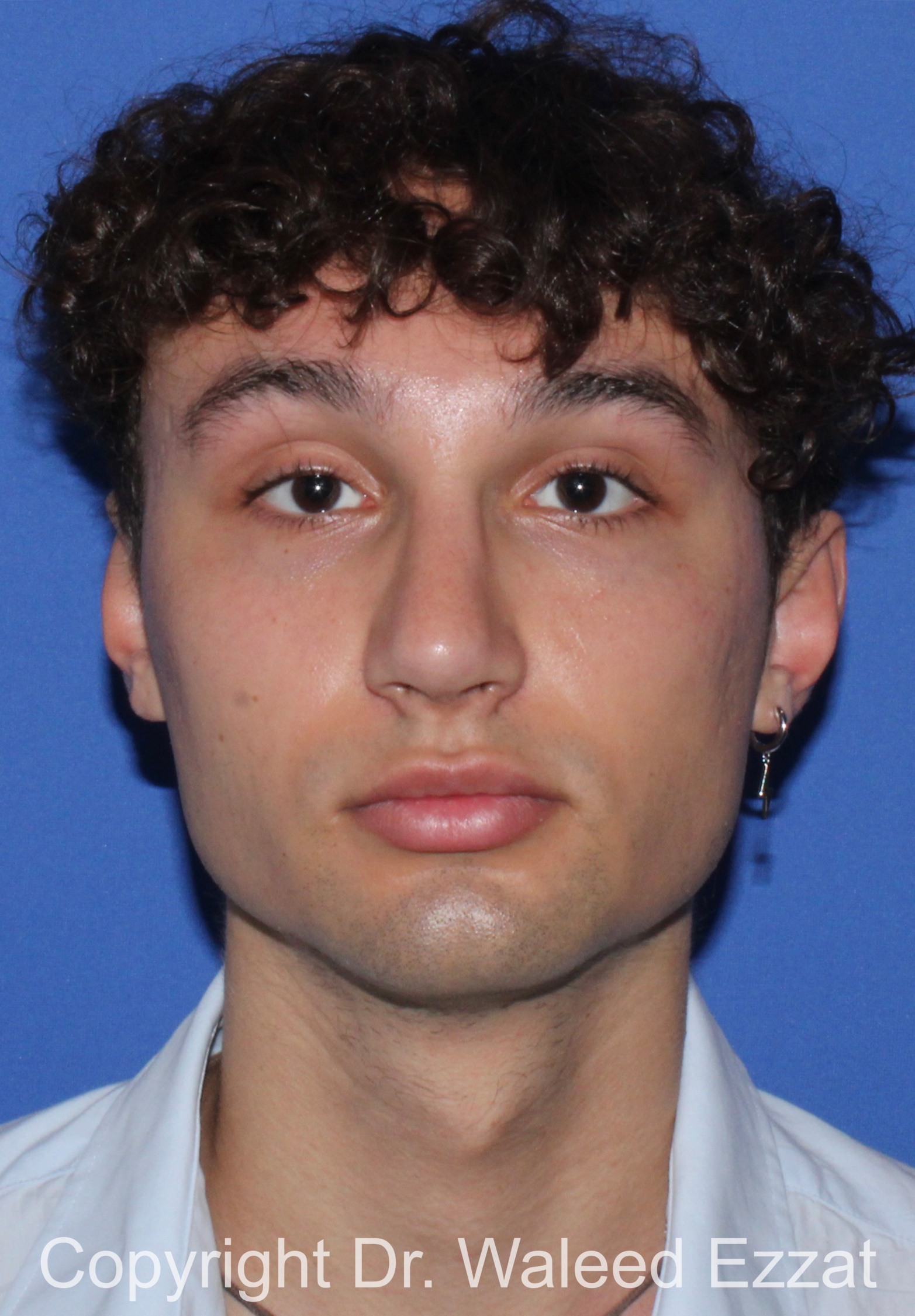 Male Rhinoplasty Patient Photo - Case 65 - after view-2