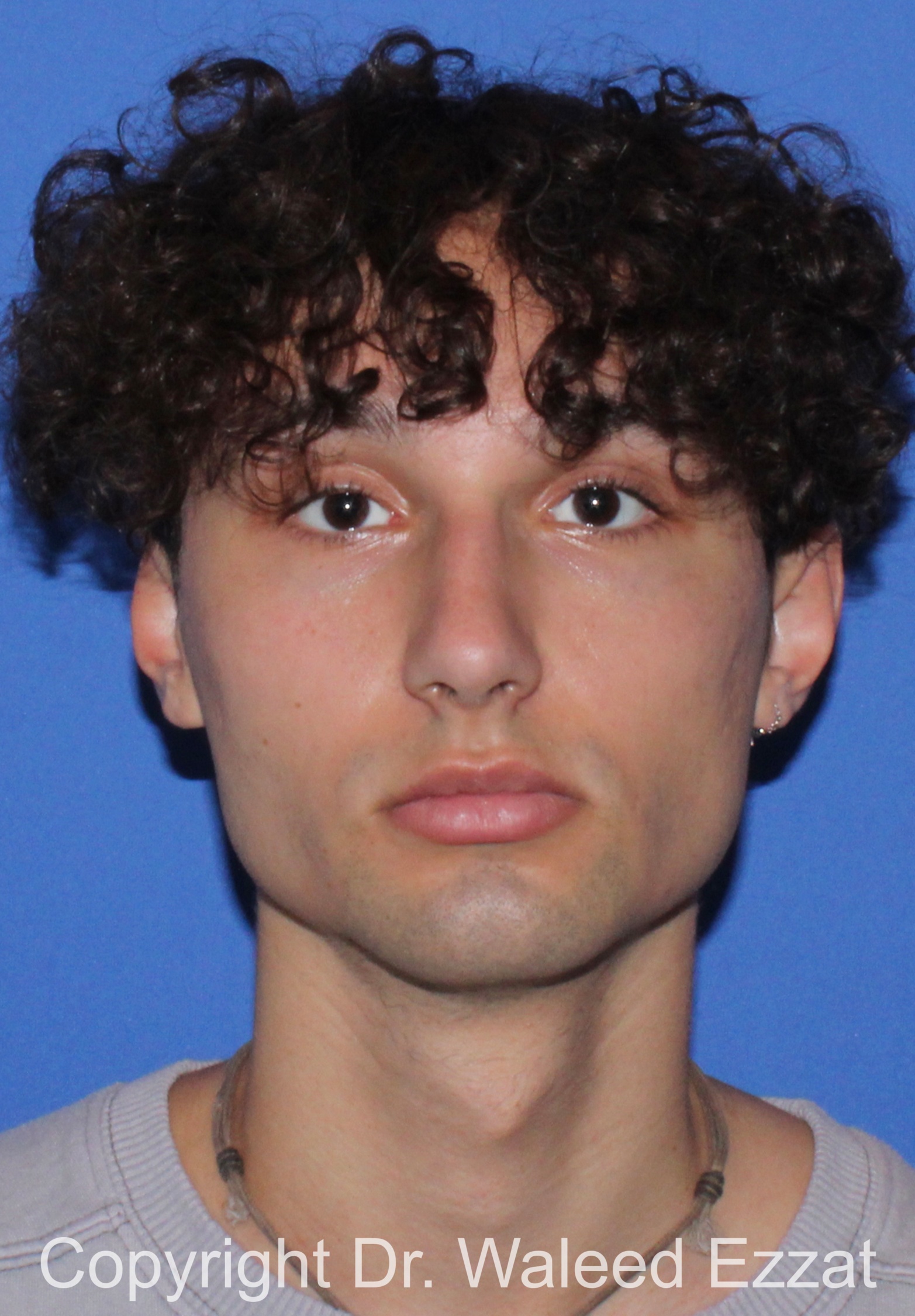 Male Rhinoplasty Patient Photo - Case 65 - before view-2