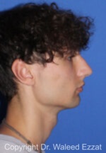 Male Rhinoplasty - Case 65 - Before