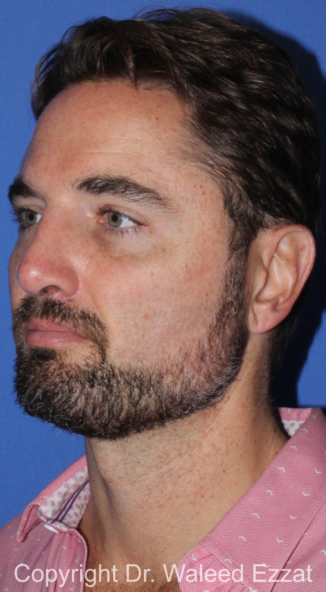 Male Rhinoplasty Patient Photo - Case 67 - after view-1