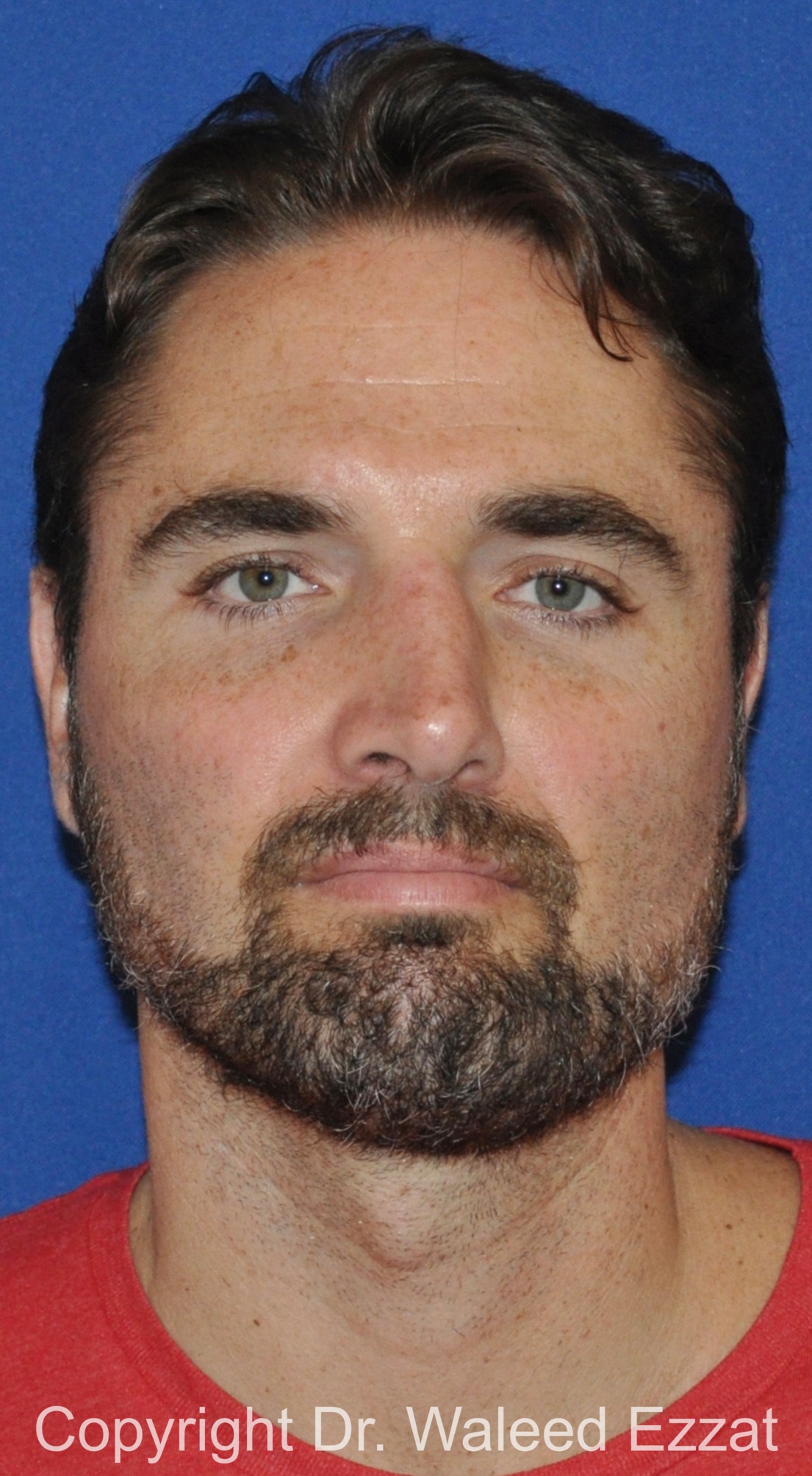 Male Rhinoplasty Patient Photo - Case 67 - before view-2