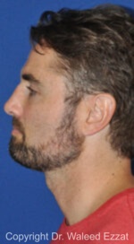 Male Rhinoplasty - Case 67 - Before