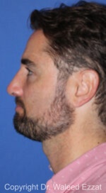 Male Rhinoplasty - Case 67 - After