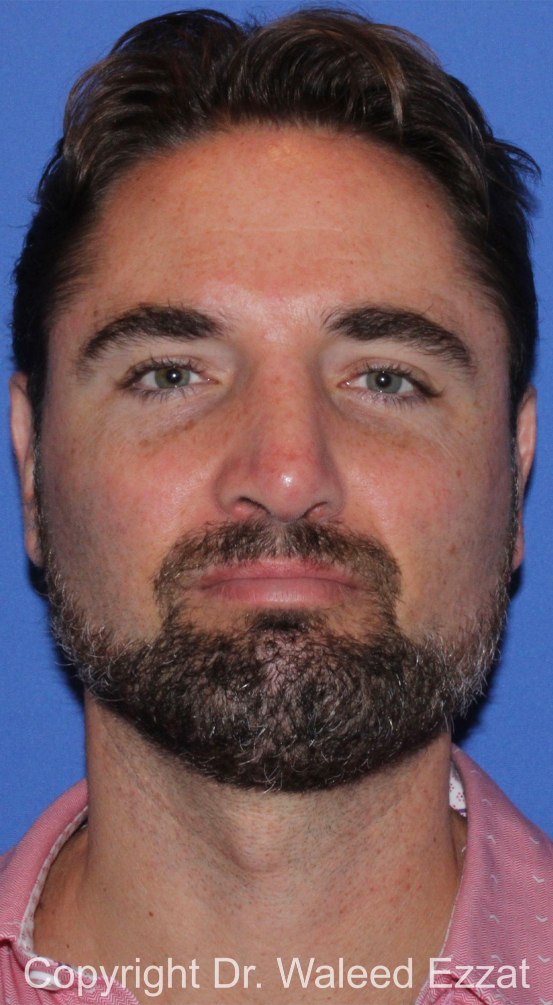 Male Rhinoplasty Patient Photo - Case 67 - after view-2