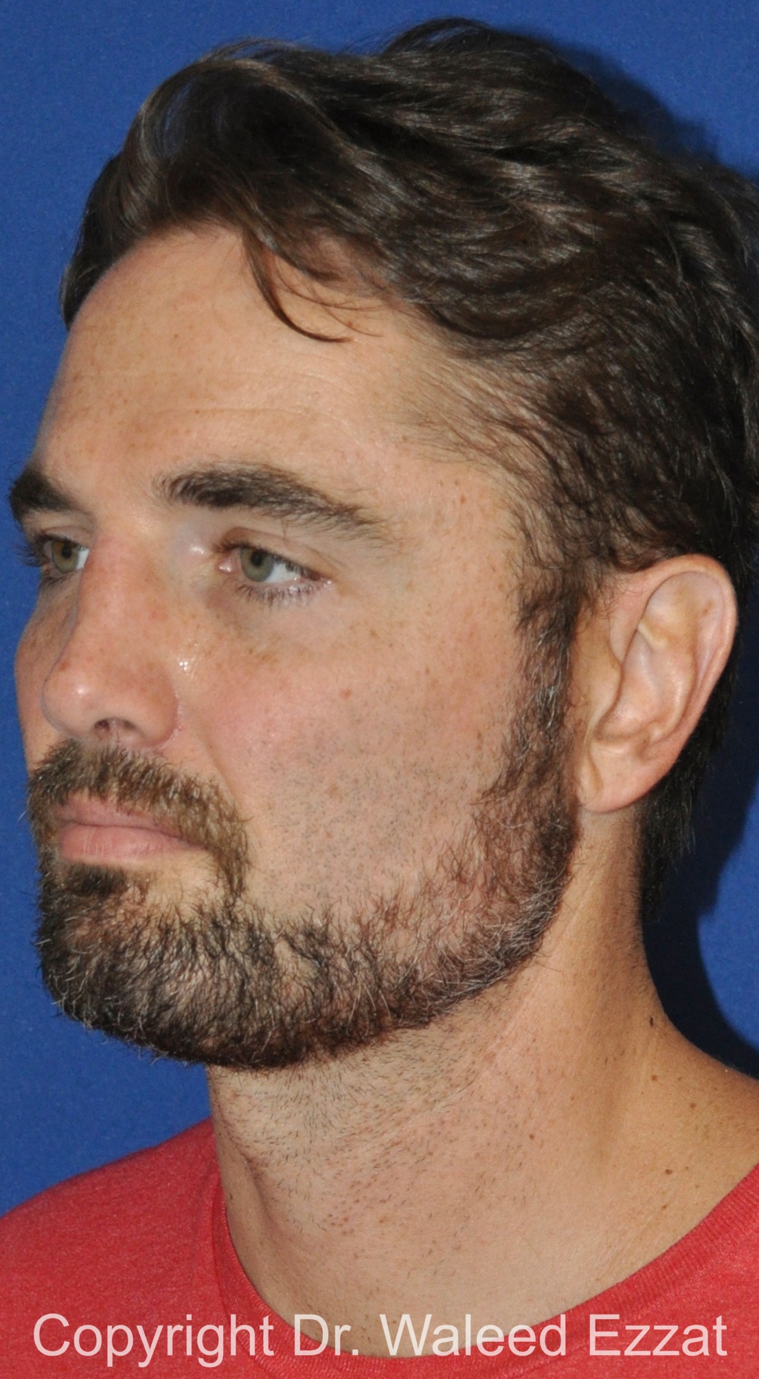 Male Rhinoplasty Patient Photo - Case 67 - before view-1